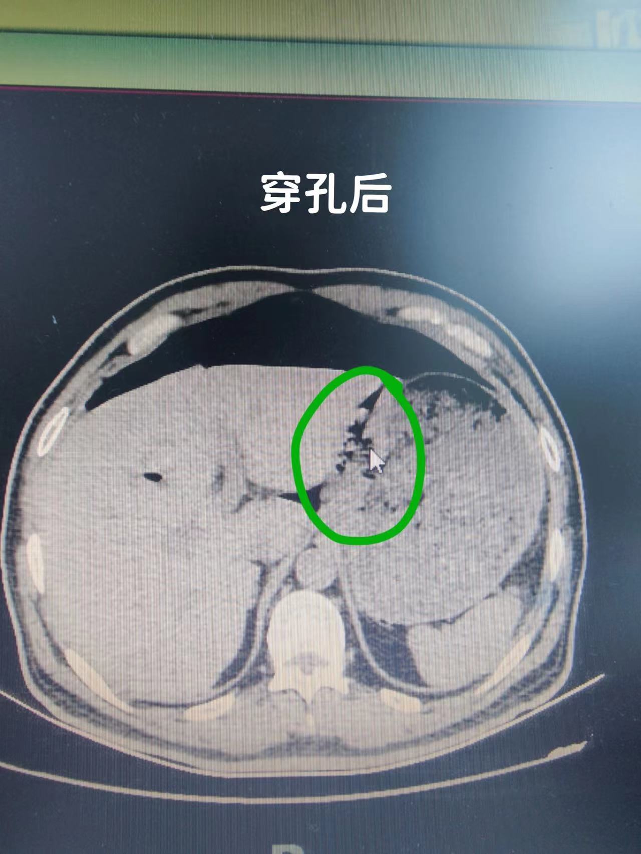 胃穿孔手术后多久能恢复?