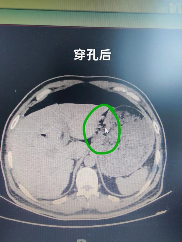 胃穿孔手术后多久能恢复?