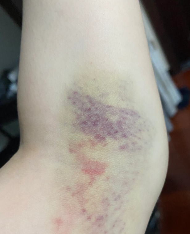 身上有淤青怎么回事?