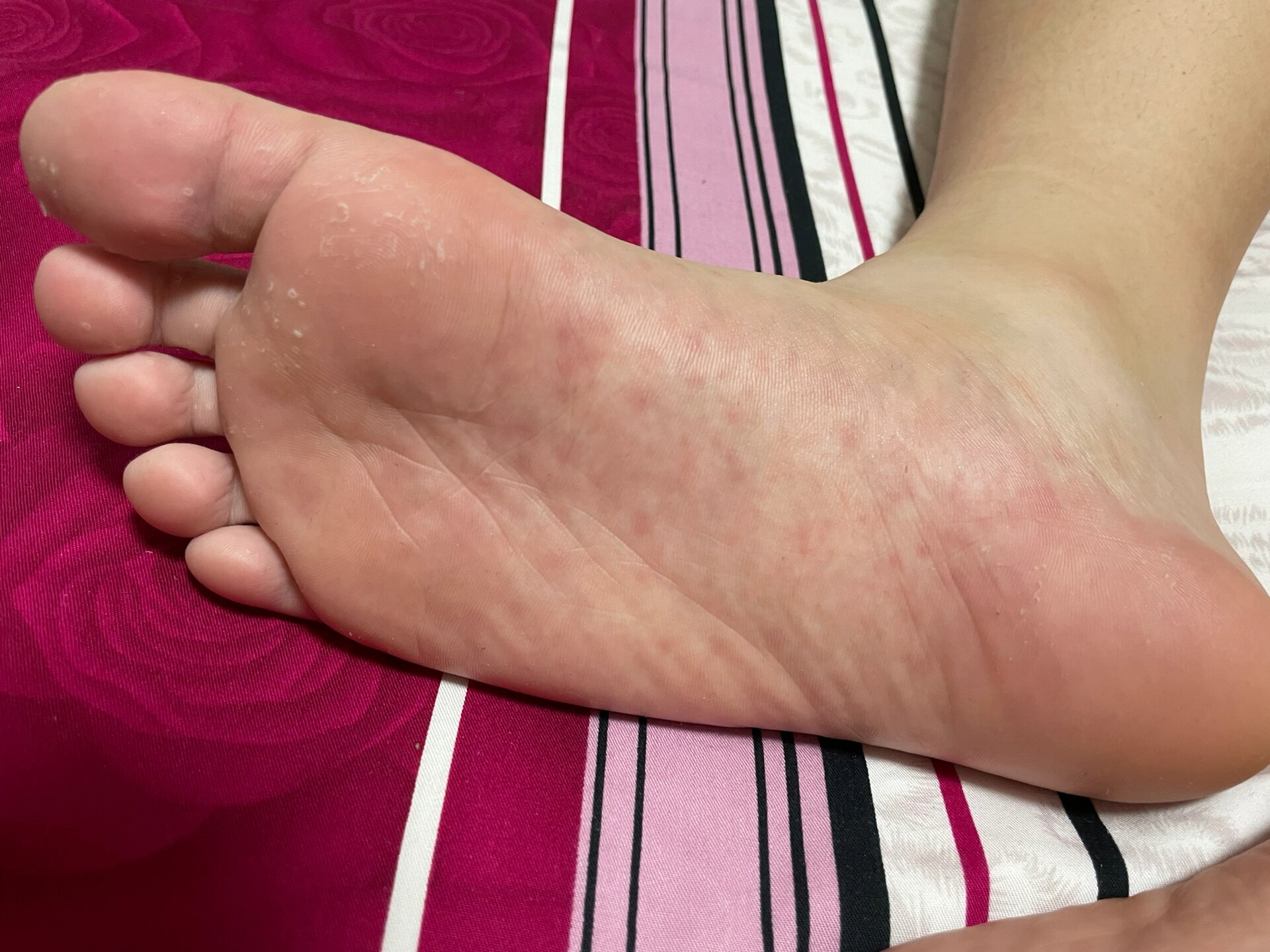 脚上起红点是怎么回事