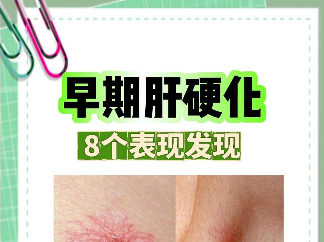 肝硬化中期症状有哪些