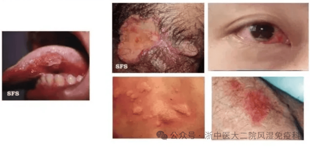 什么人容易得白塞氏病