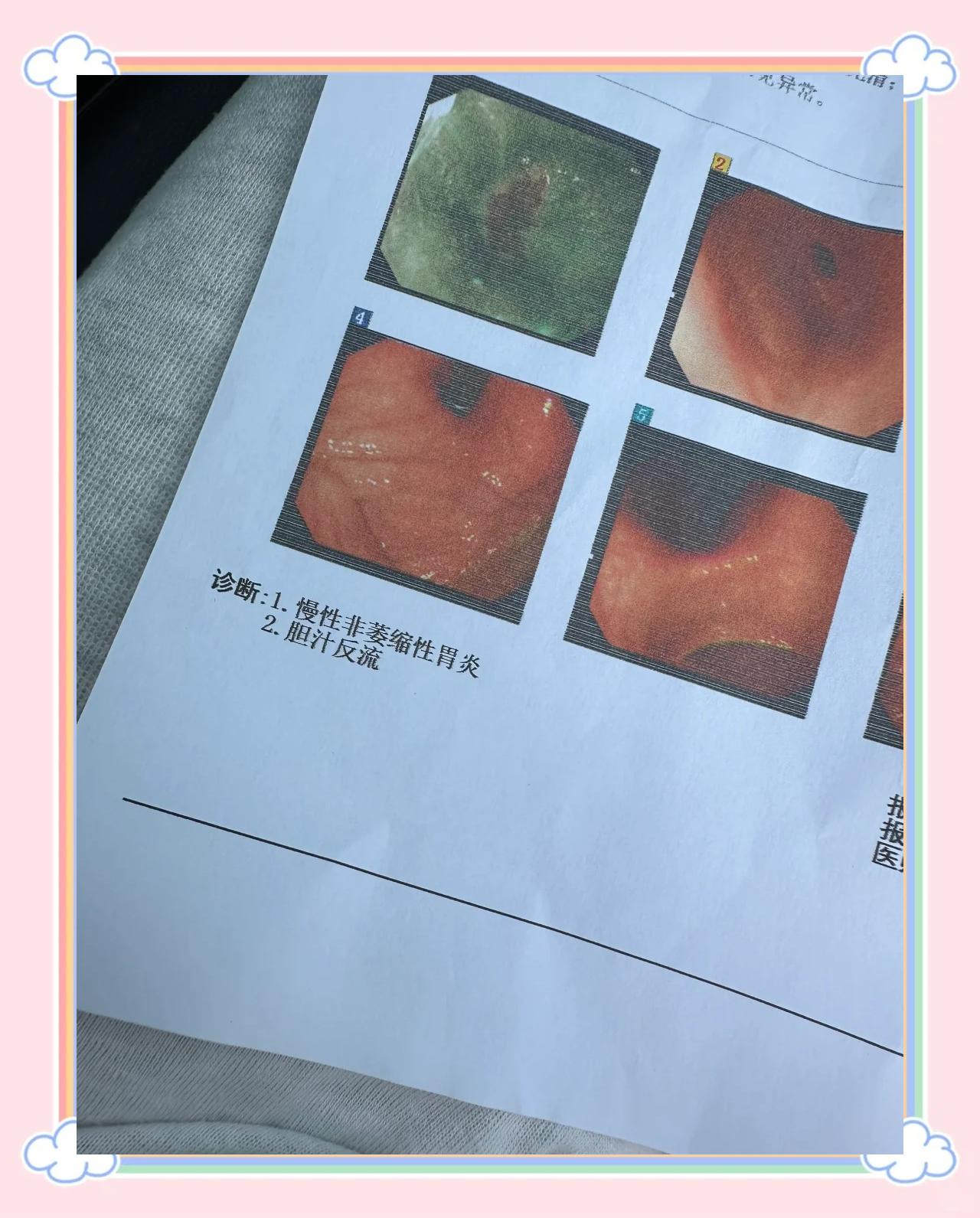 胃镜结束出现胃痛正常吗