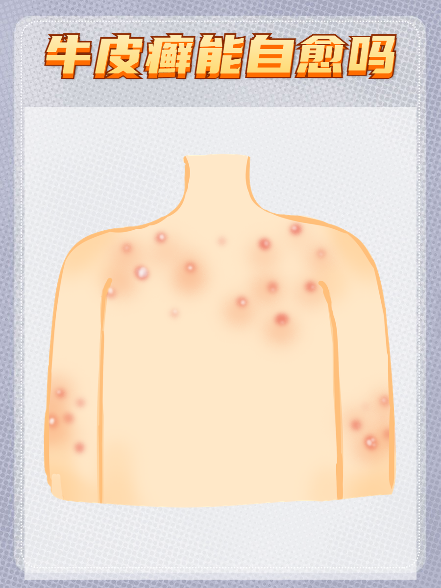 牛皮癣可以治愈吗?会遗传吗?