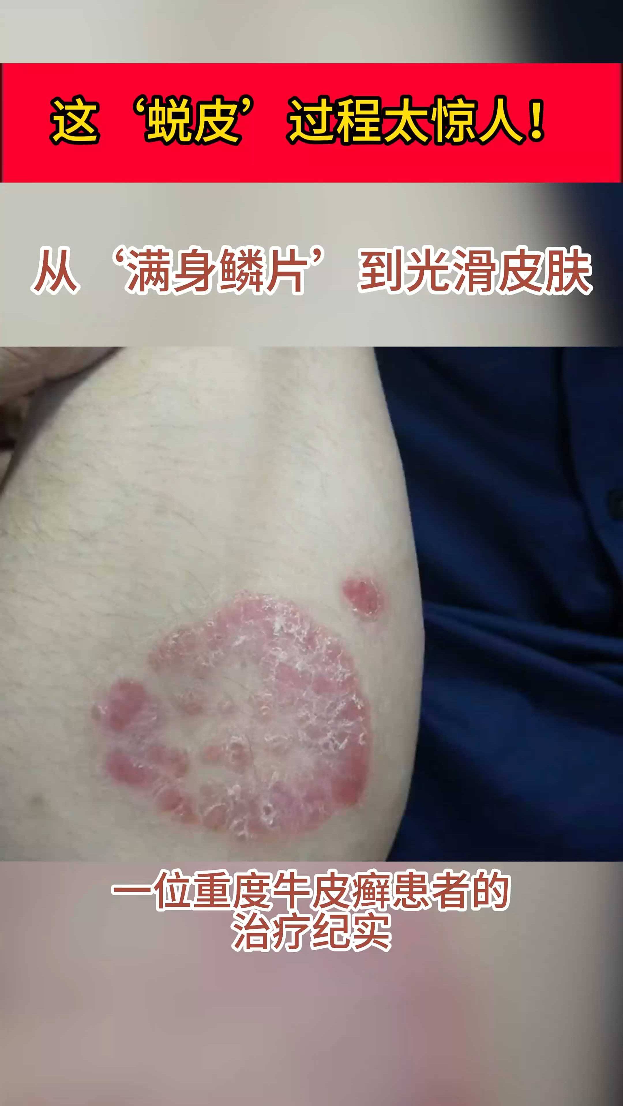 牛皮癣可以治愈吗?会遗传吗?