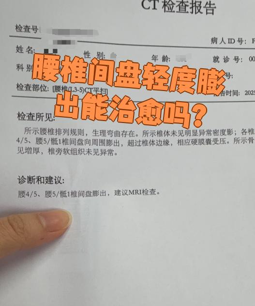 腰椎间盘膨出可以治愈吗?