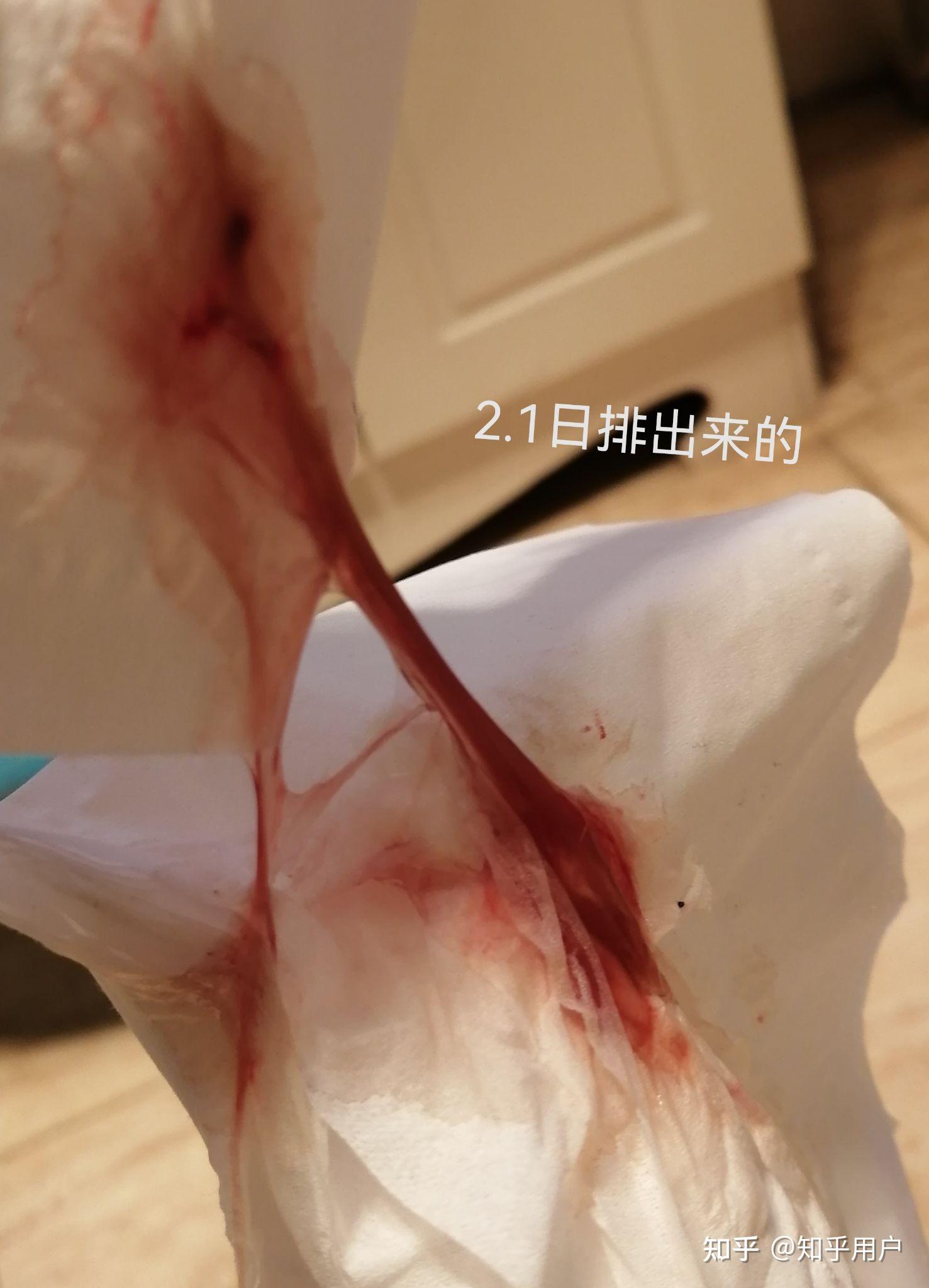 药流后第一次月经