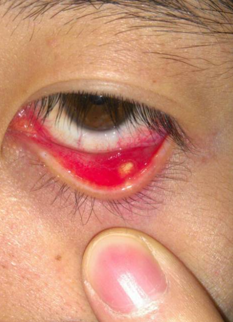 眼睑长脂肪粒怎么办