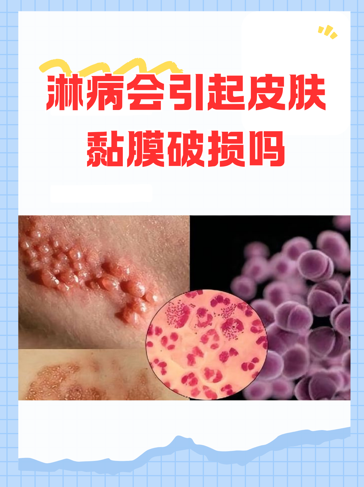 淋球菌感染是什么病大夫