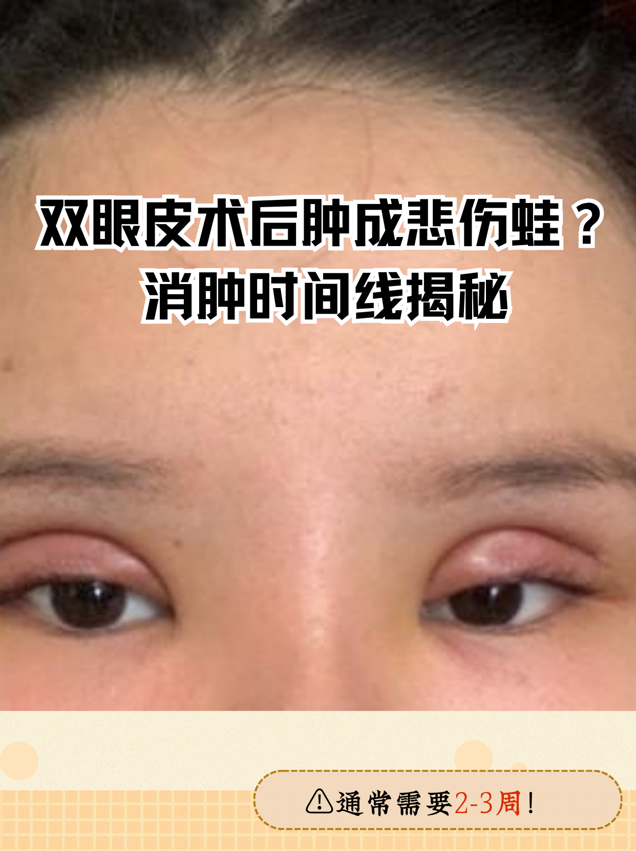 割双眼皮怎么消肿快?