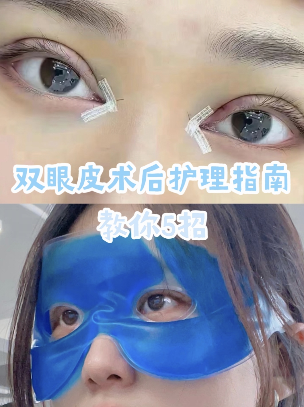 割双眼皮怎么消肿快?