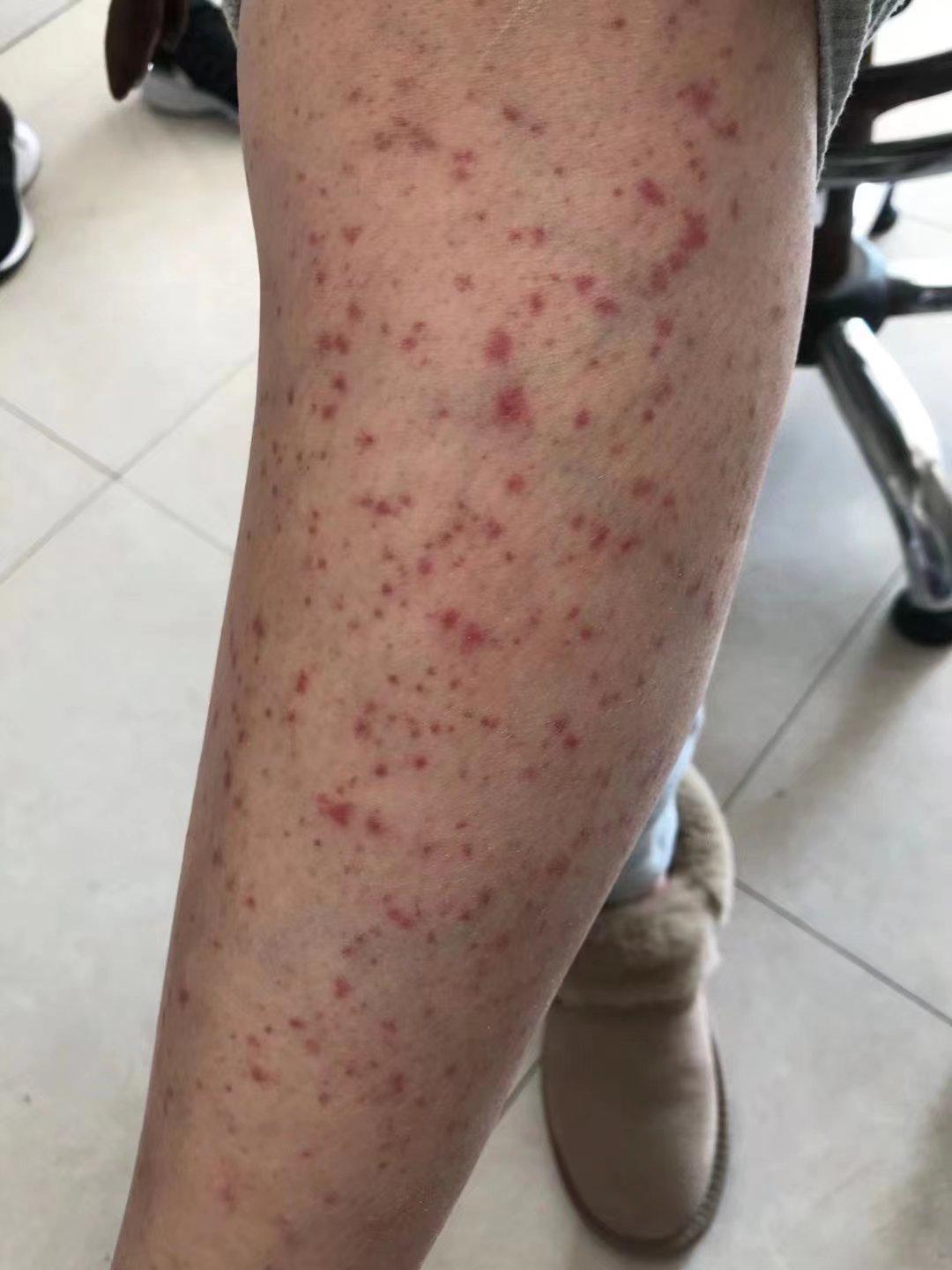 什么是过敏紫癜性肾炎