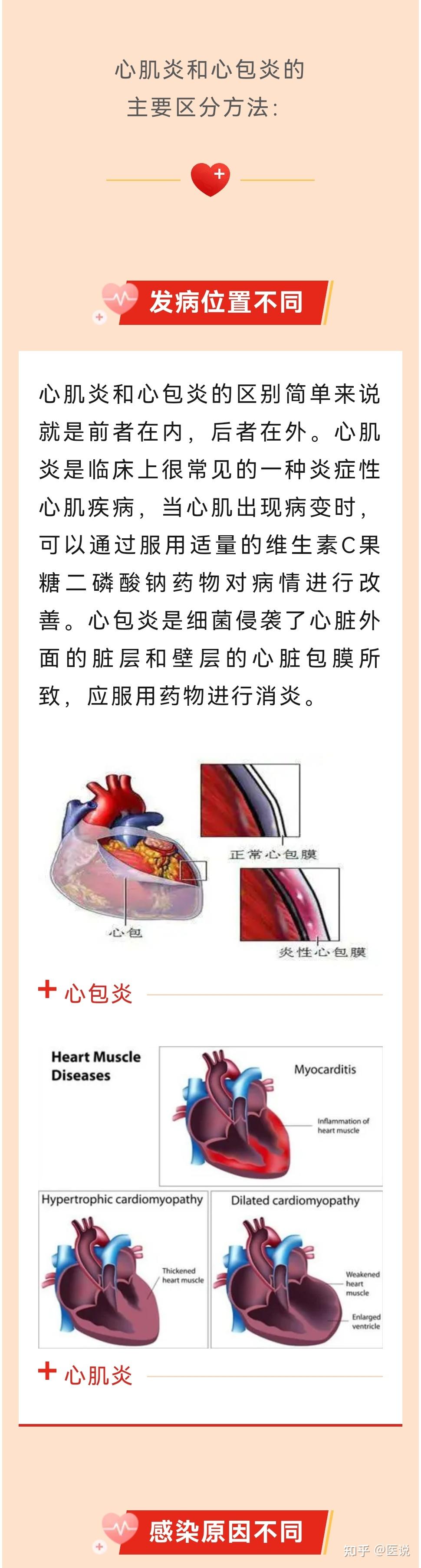 什么是病毒性心肌炎?