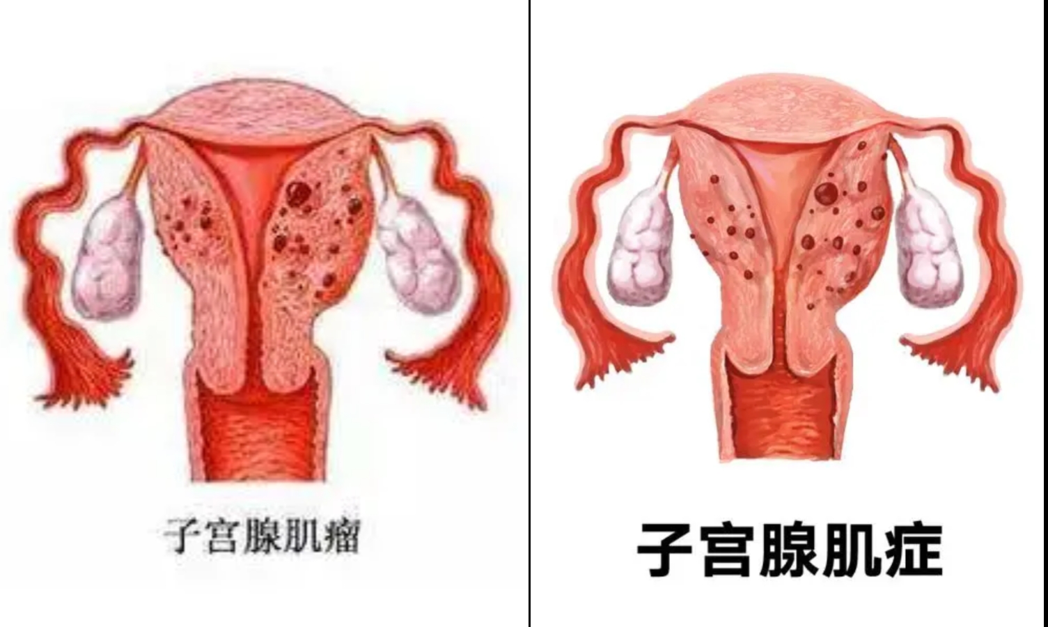 小子宫肌瘤会消失吗
