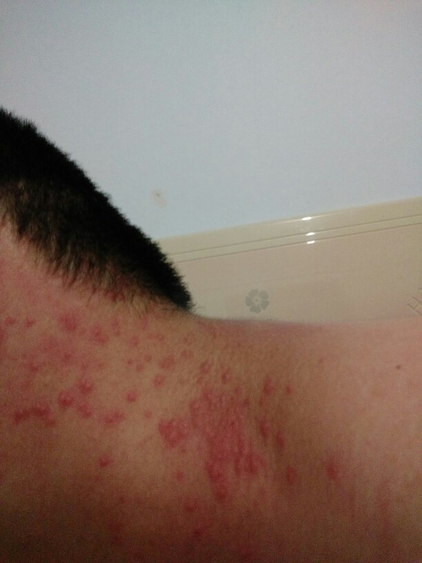 脖子上起小红疙瘩,很痒