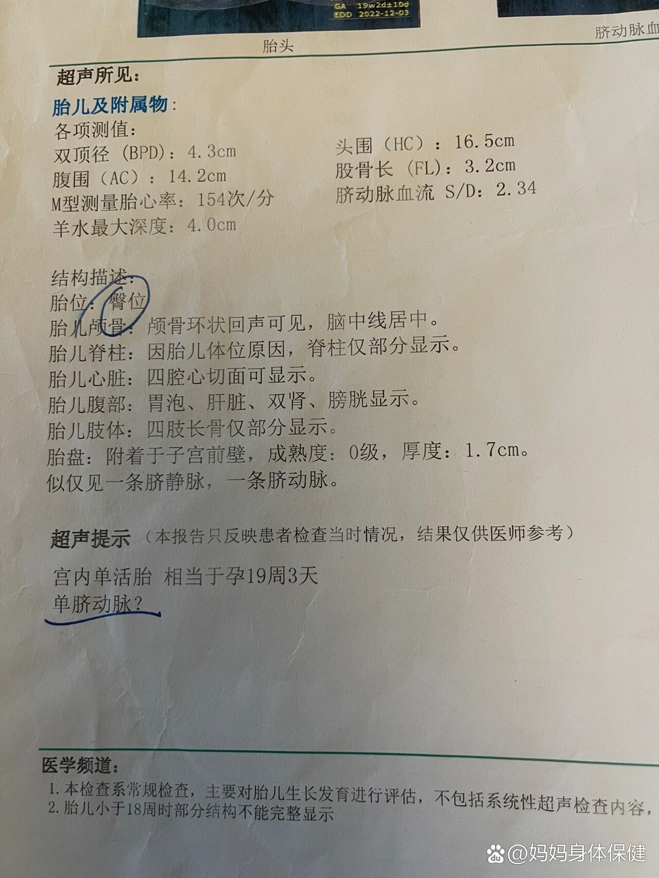 单脐动脉对胎儿发育影响吗