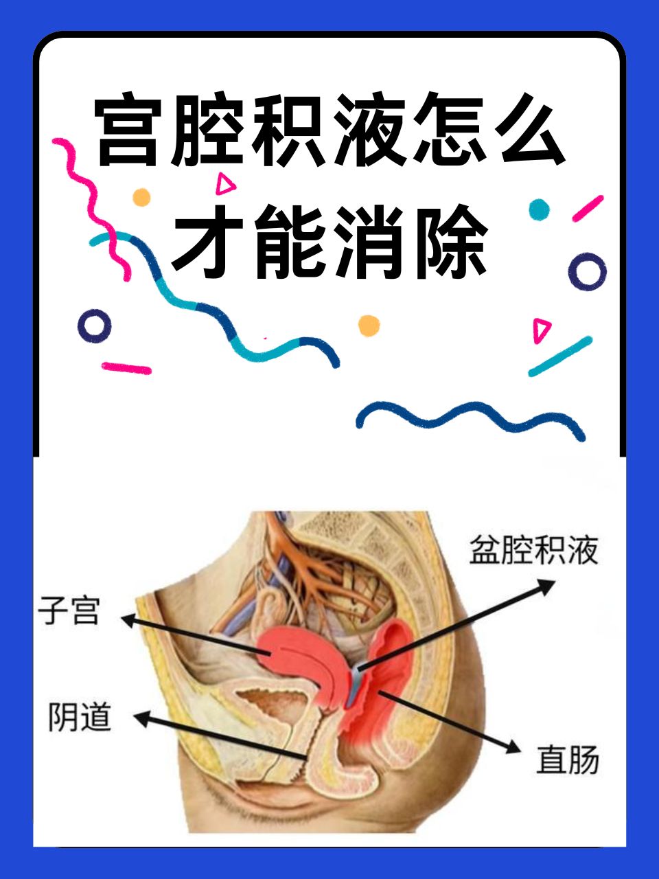 慢性盆腔积液的症状有哪些