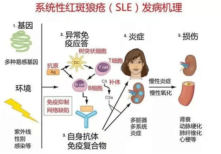 系统性红斑狼疮肾炎是什么病