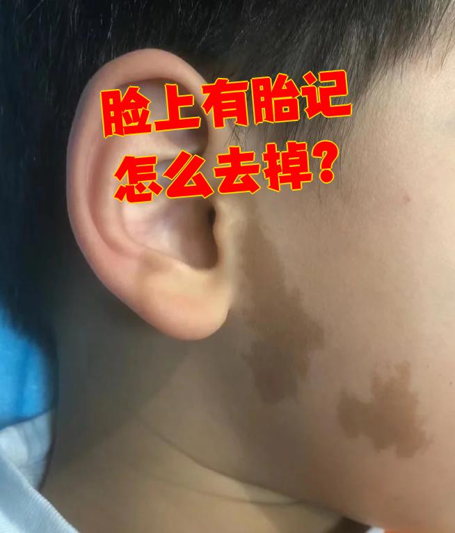 胎记可以彻底去除掉吗?