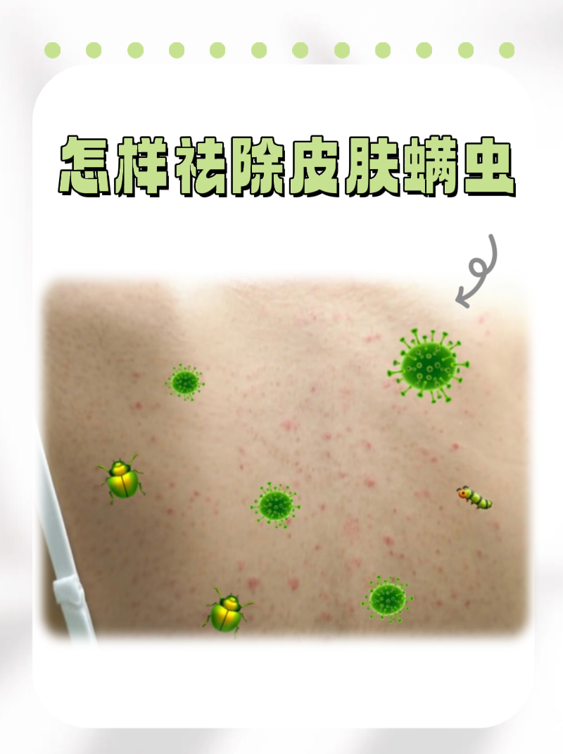 螨虫性皮炎的危害