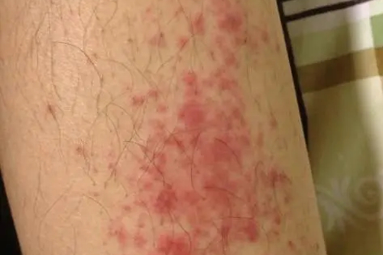 螨虫性皮炎的危害