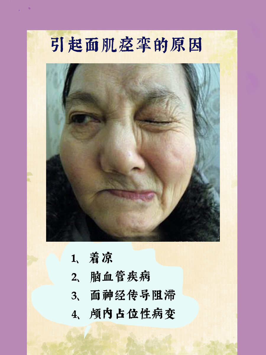 面肌痉挛是什么病