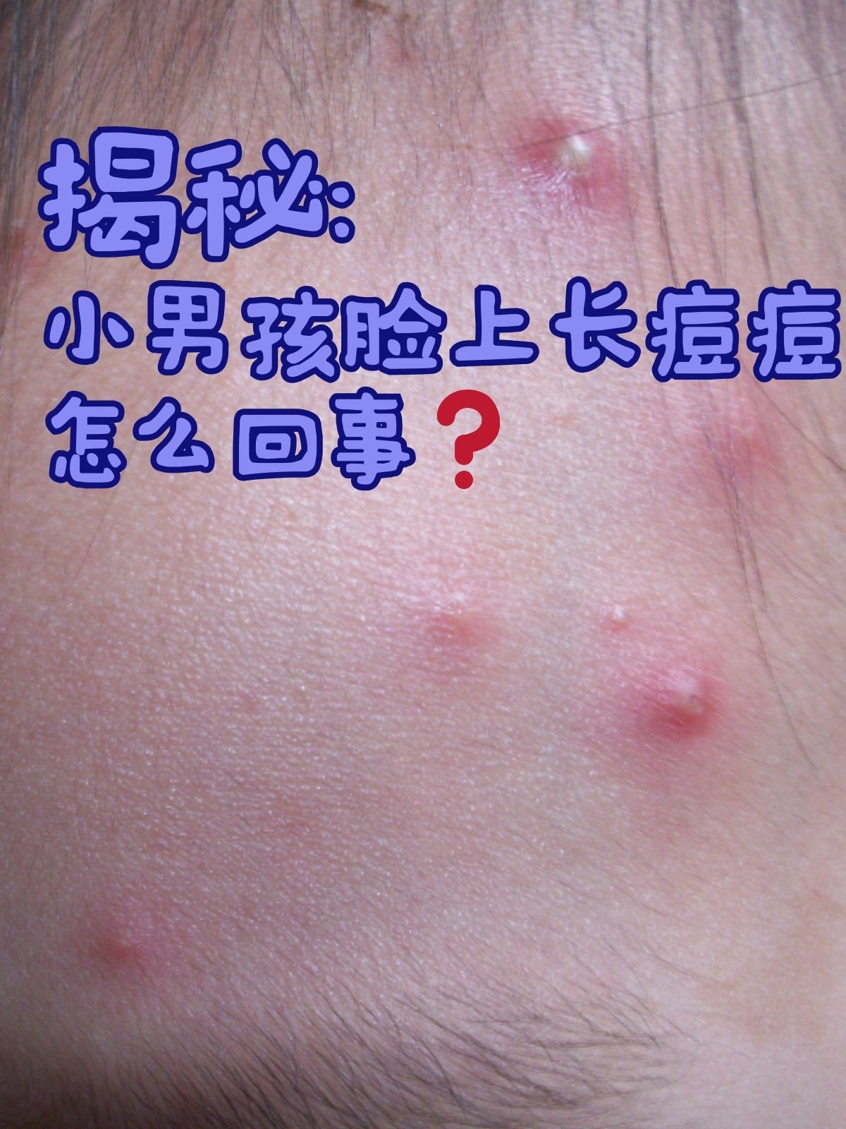 脸上长痘痘是怎么回事