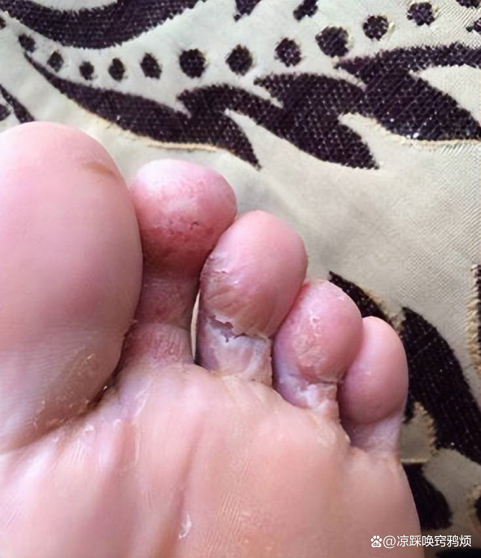 双脚磨出水泡怎么处理好得快