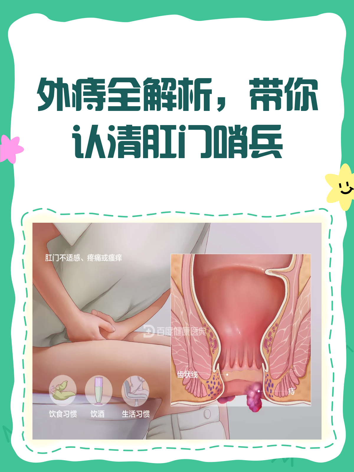 外痔有哪些症状