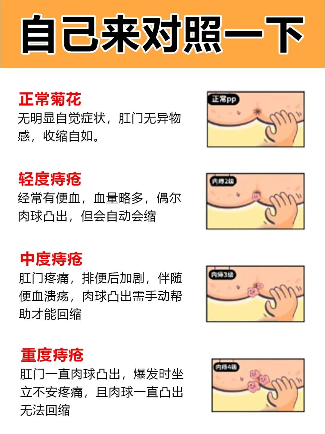 外痔有哪些症状