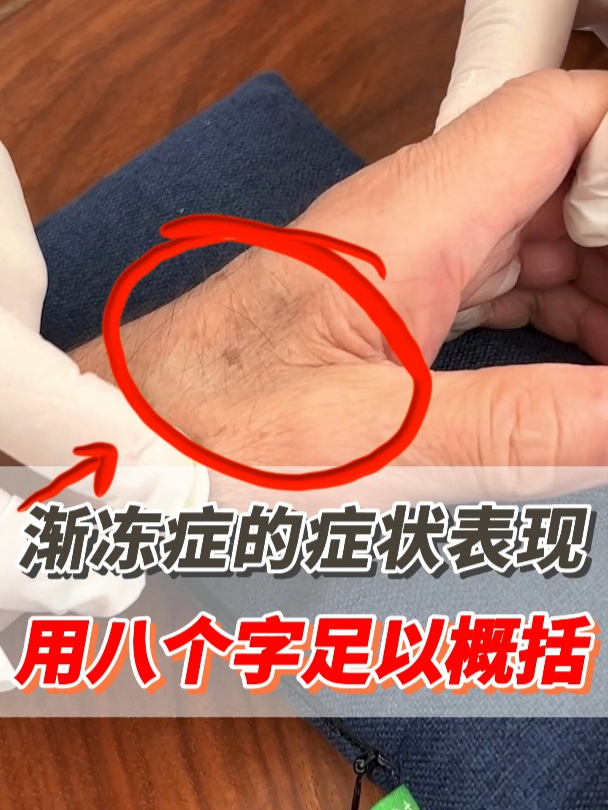 渐冻人病到底是什么病?