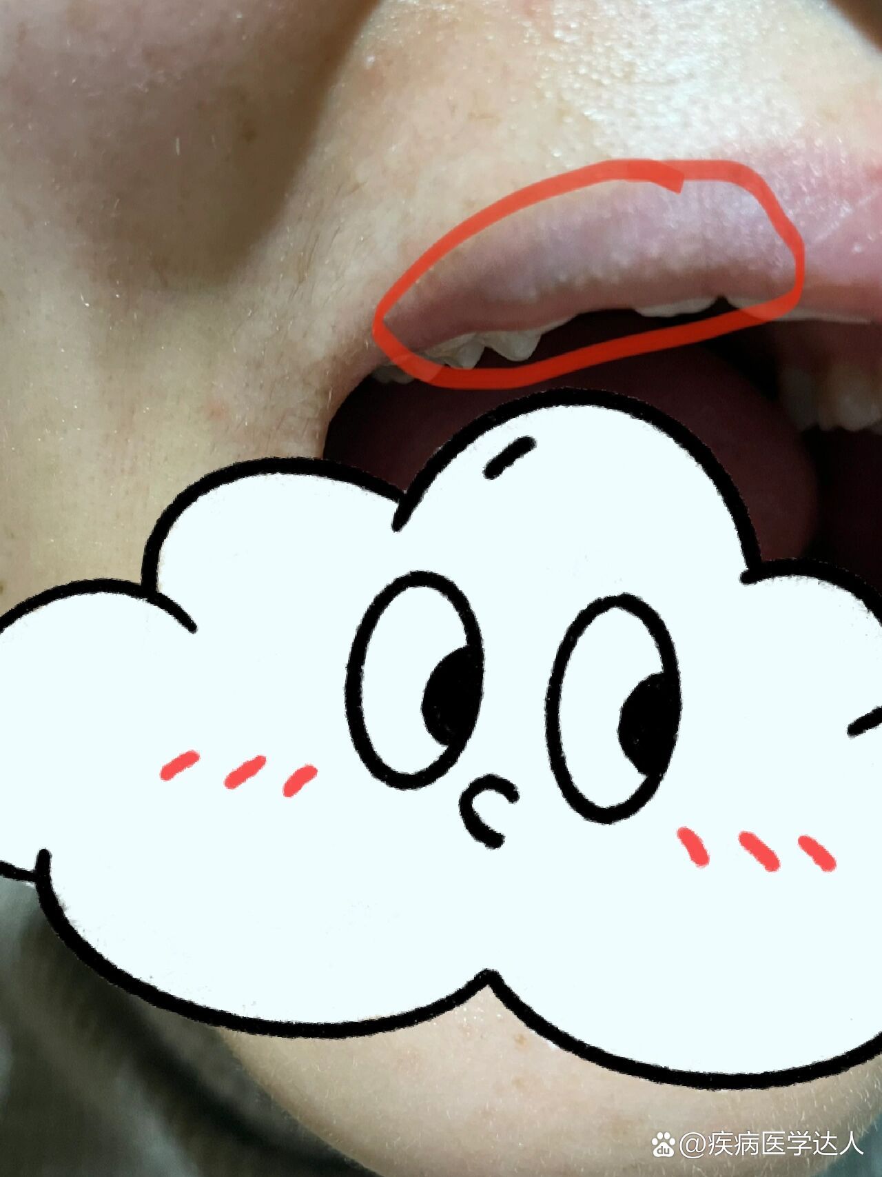 嘴唇上长小白点怎么办