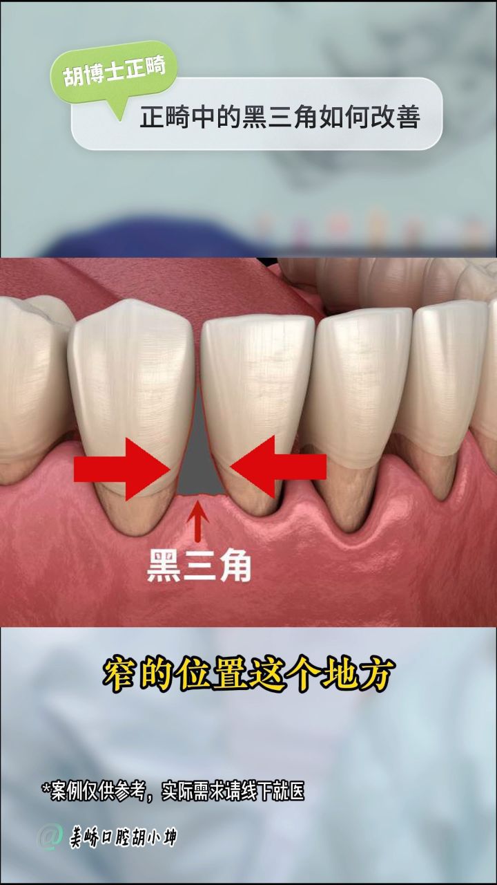 牙齿黑三角怎么补救