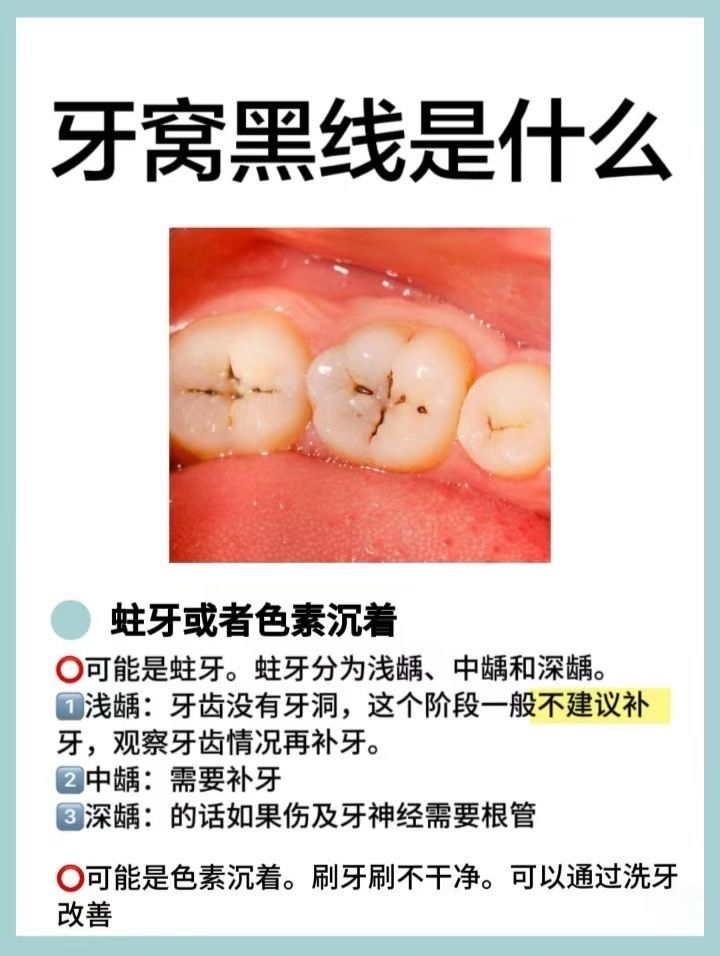 牙齿黑三角怎么补救