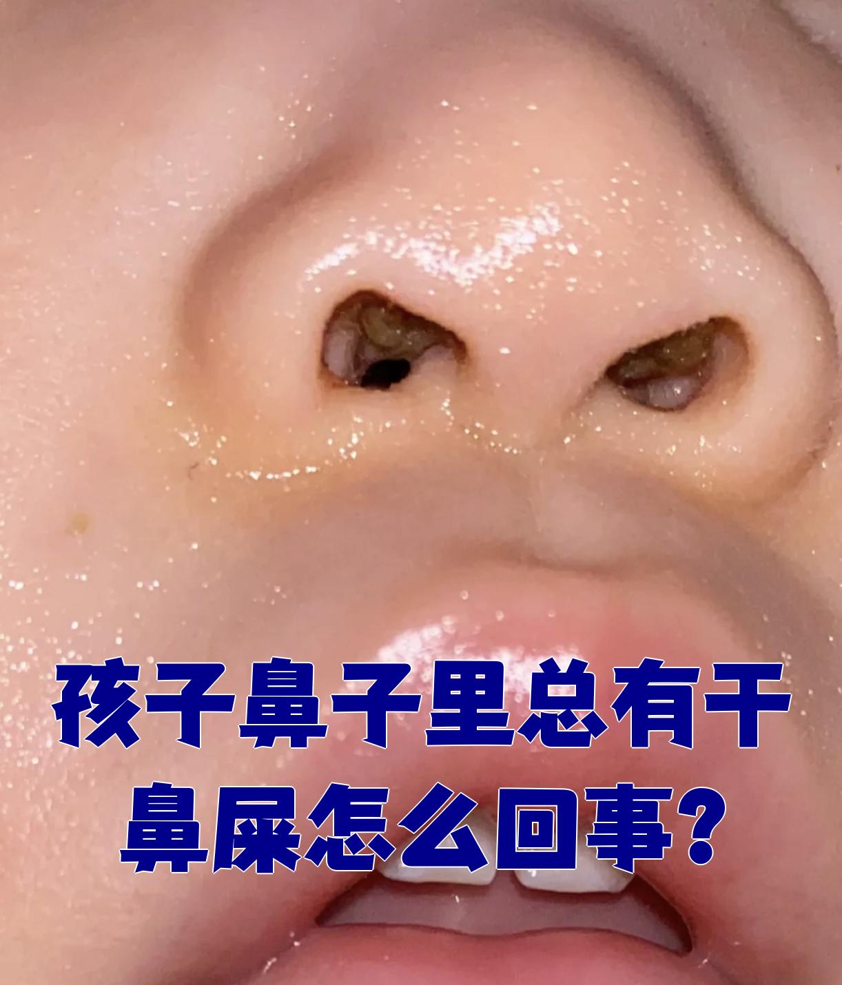 鼻子里干燥怎么办