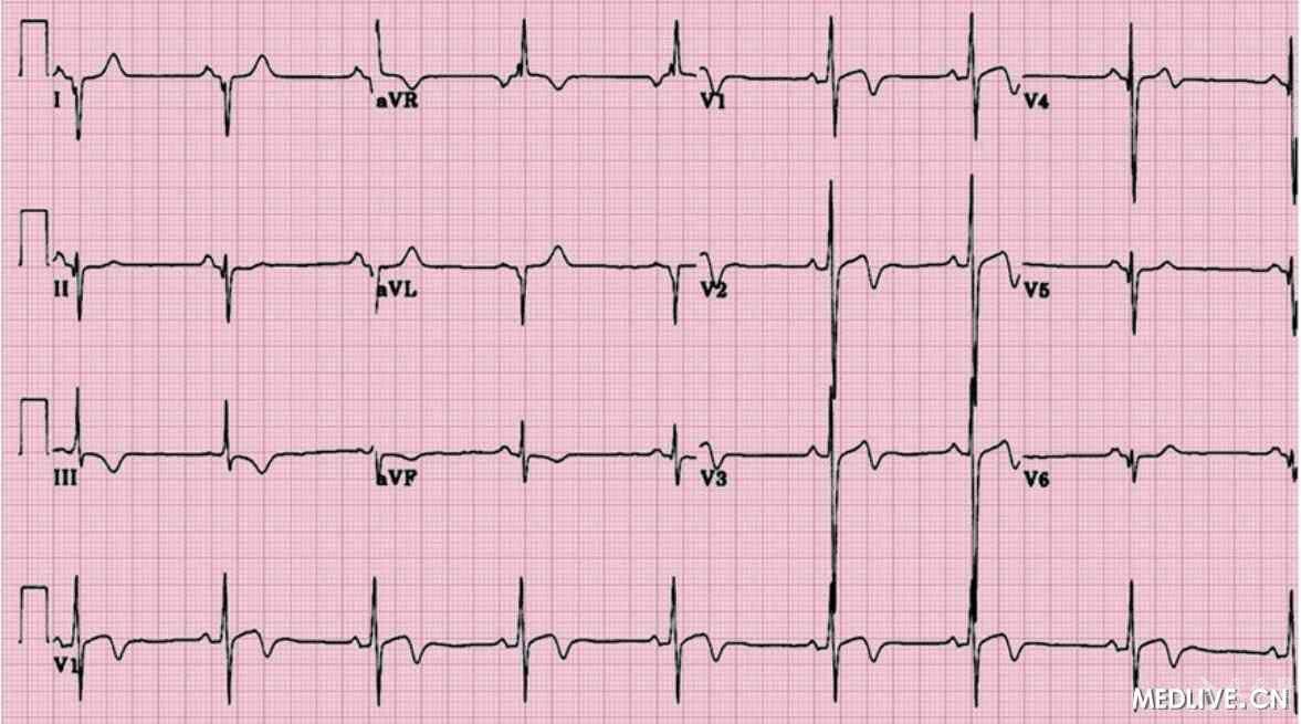 心电图心电轴右偏是什么意思