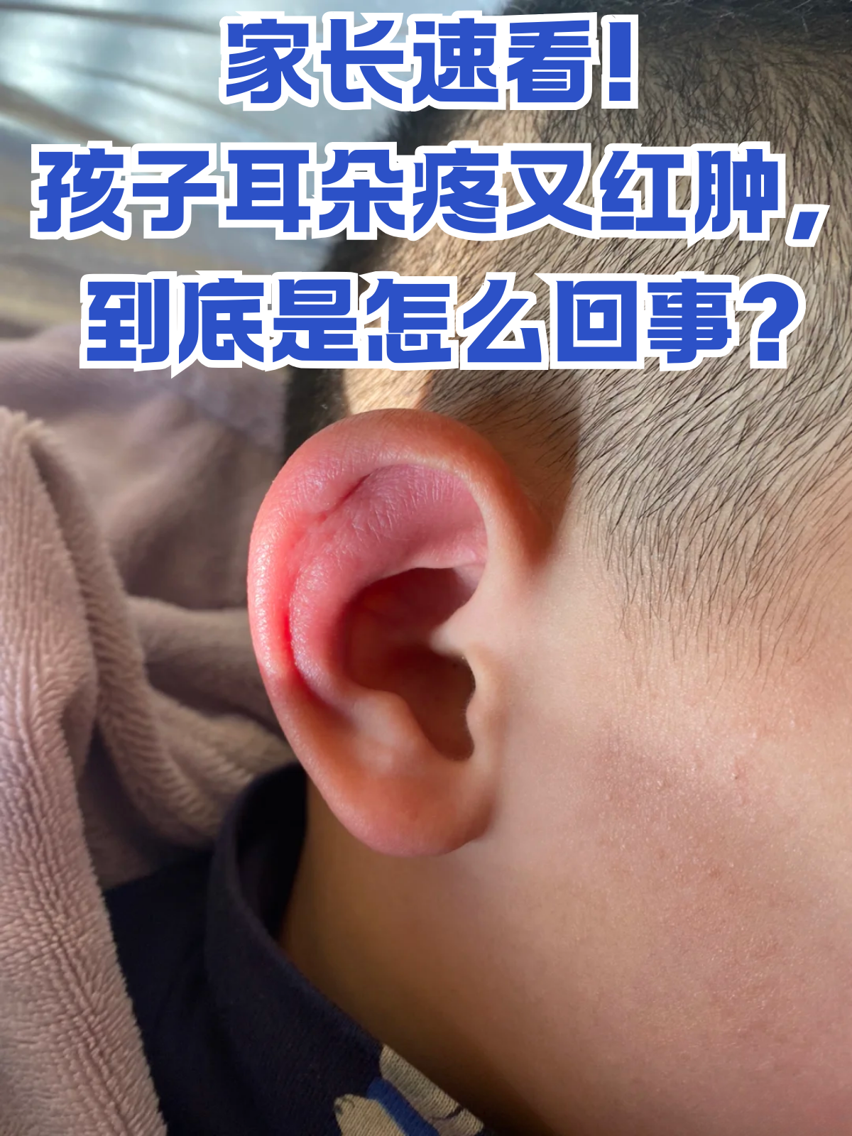 上火耳朵里面疼严重吗