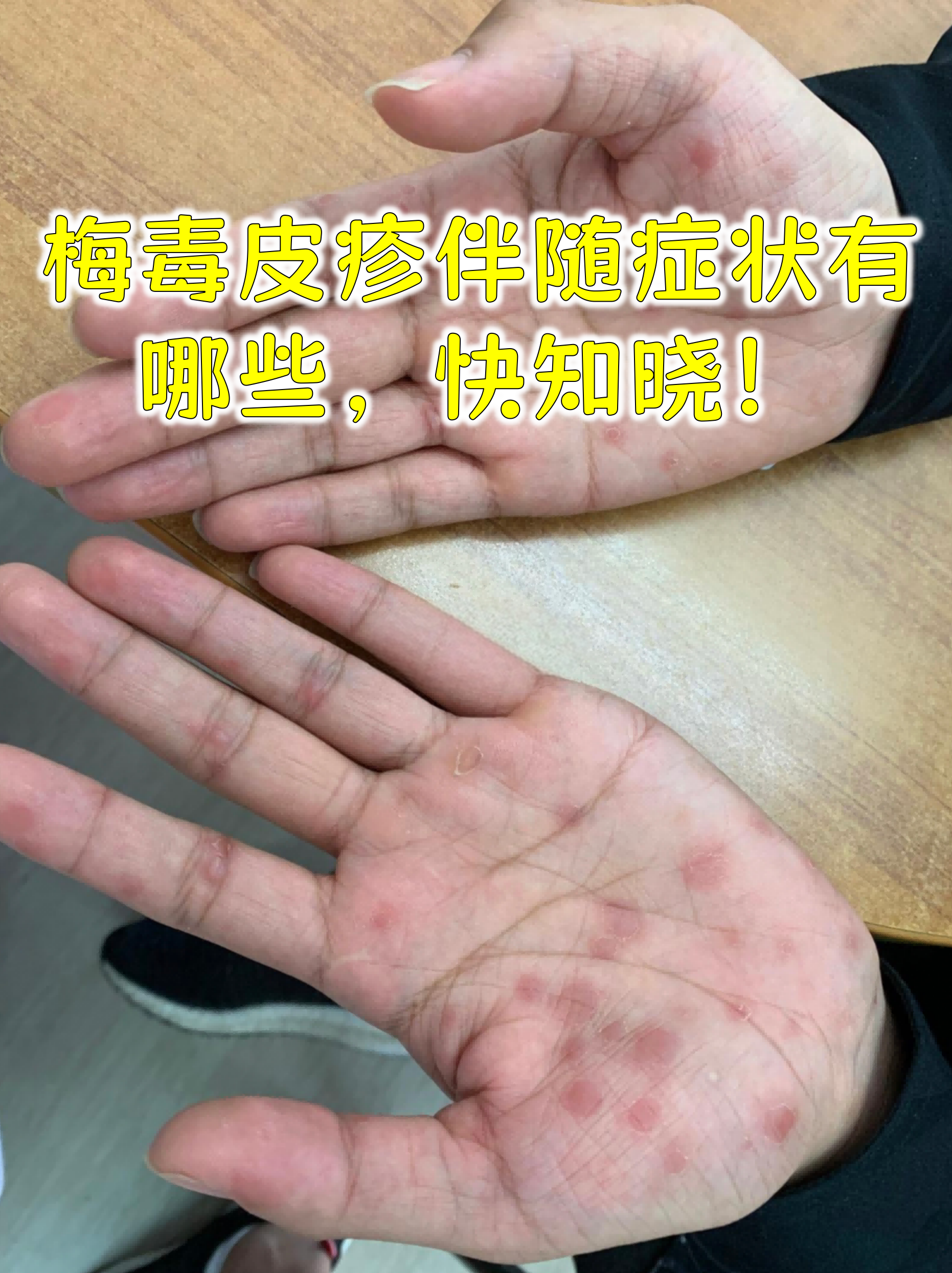 梅毒检测方法有几种