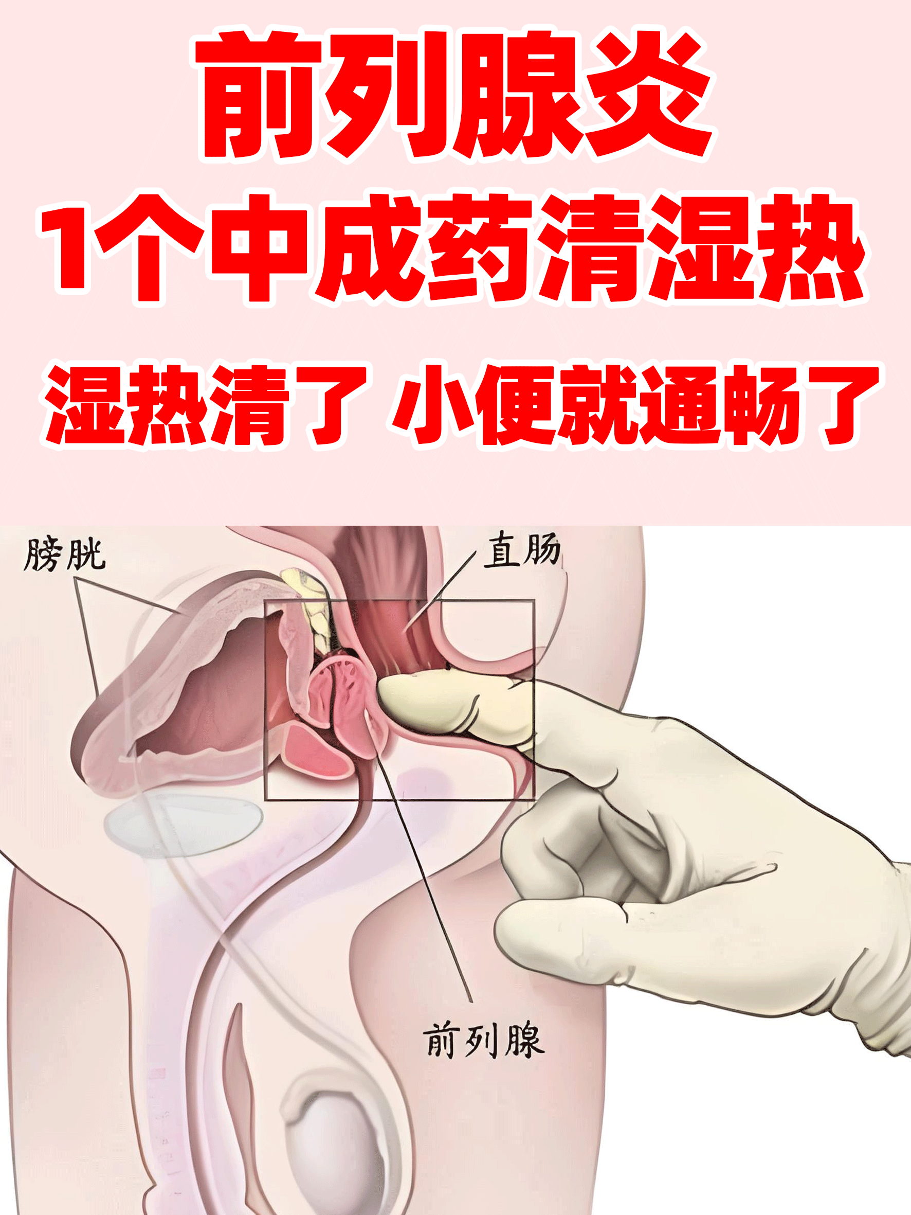 前列腺炎有哪些表现症状?