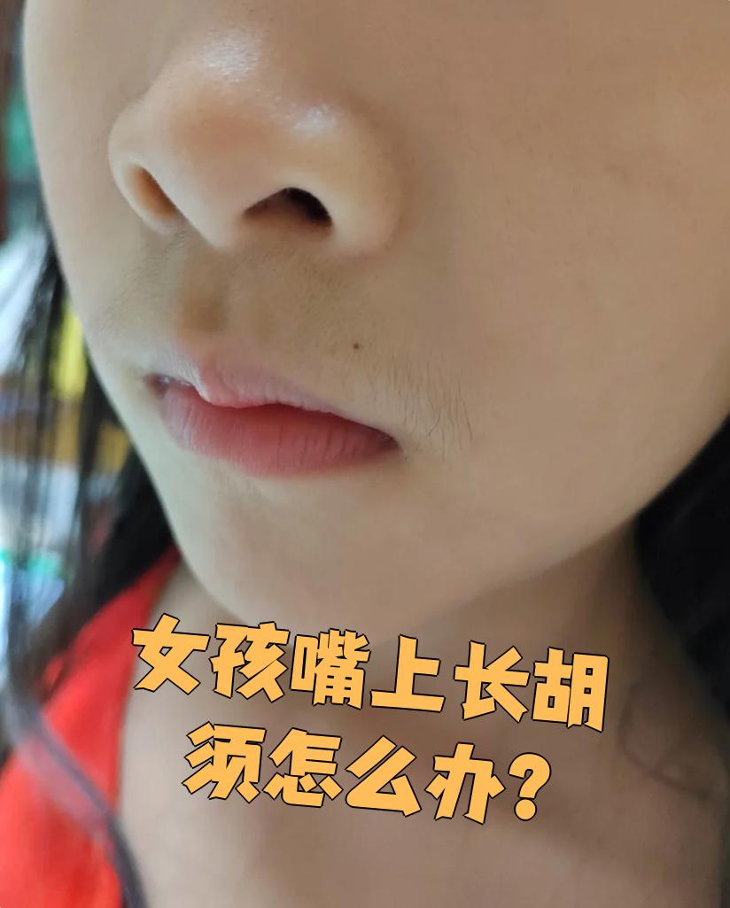 女生雄性激素过多怎么办