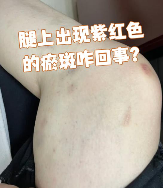 血小板减少性紫癜症状有哪些