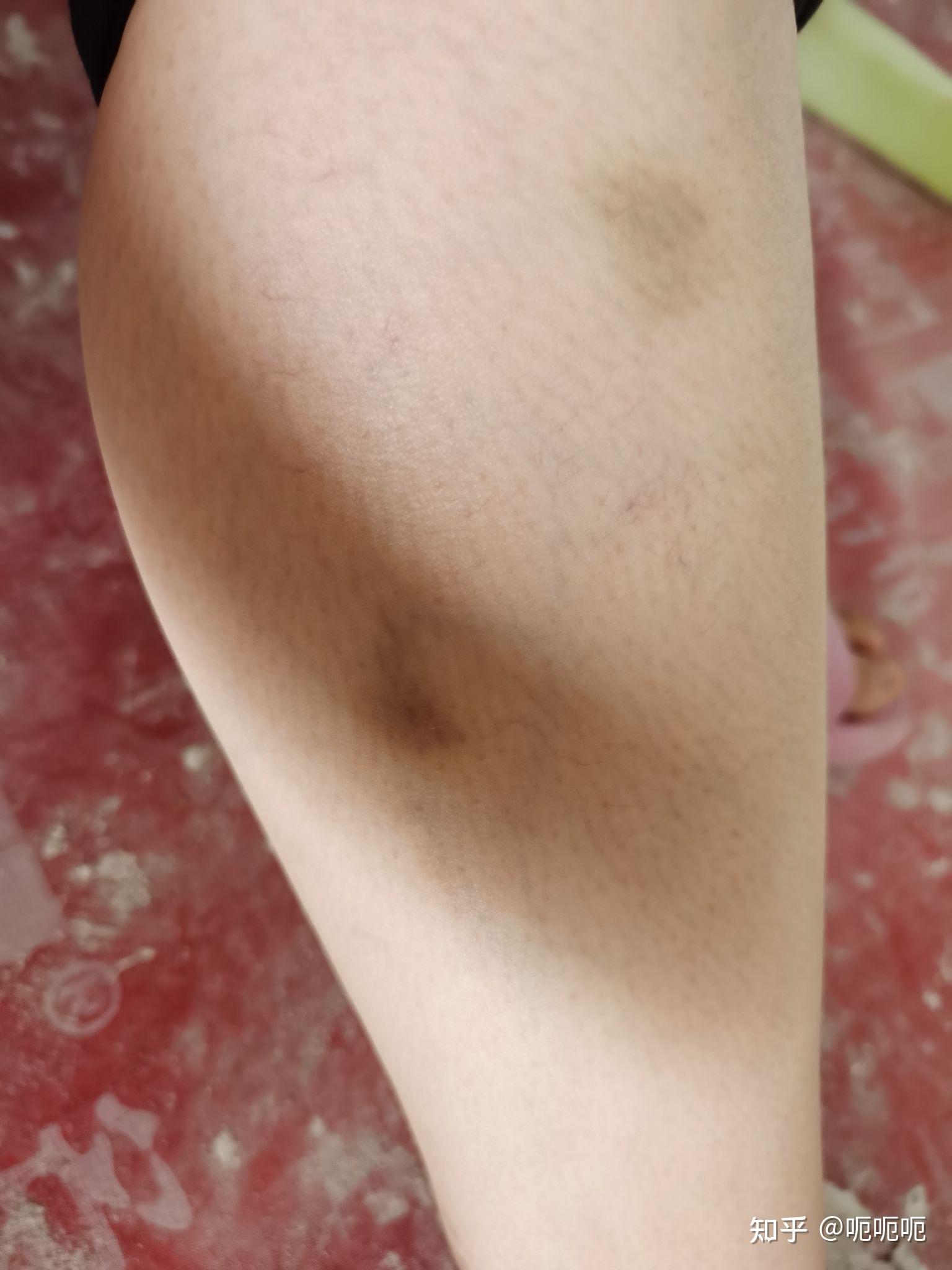 血小板减少性紫癜症状有哪些