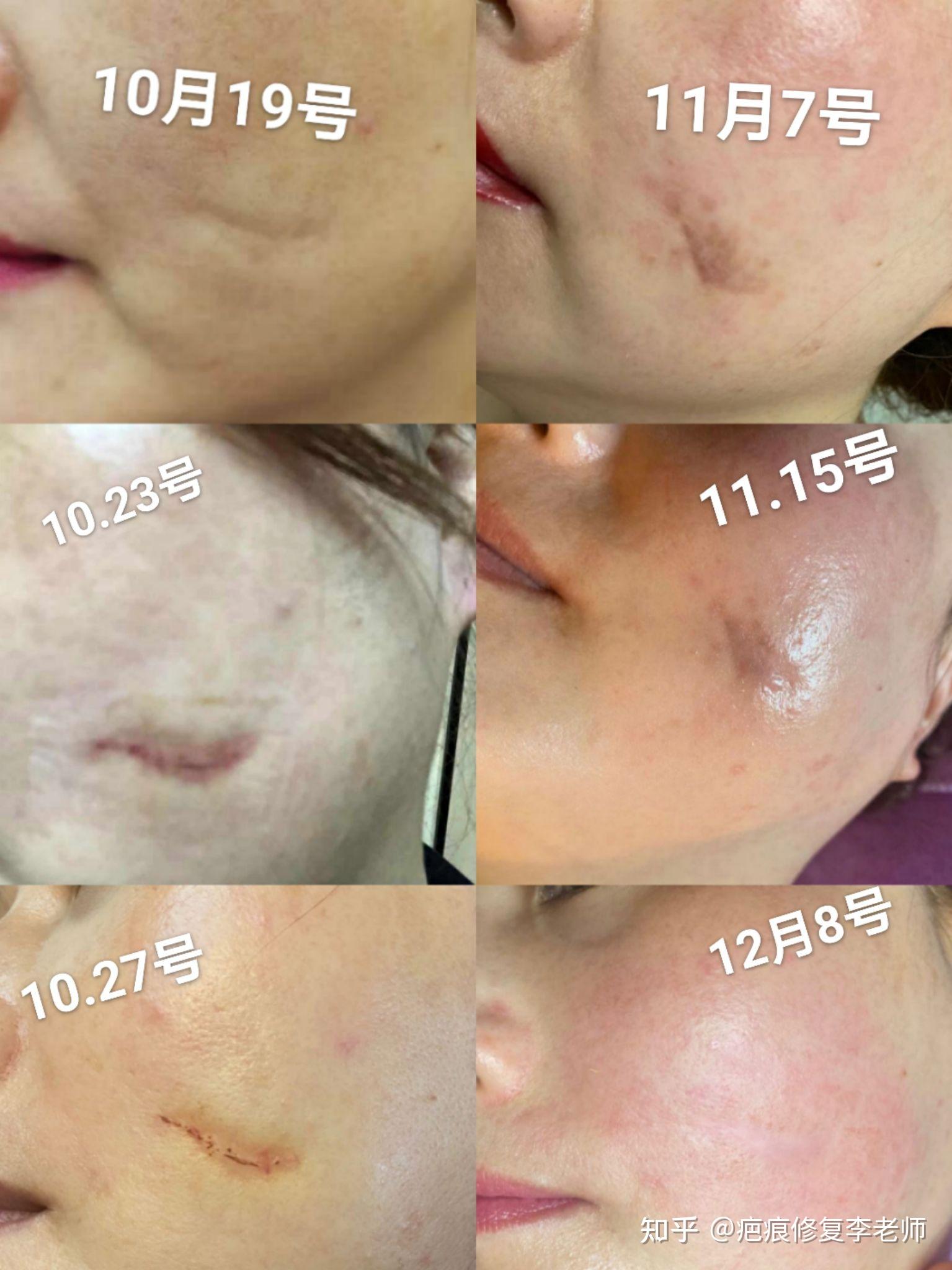 脸上有疤怎么能恢复好