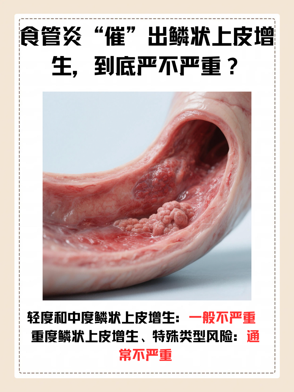 霉菌食管炎严重吗