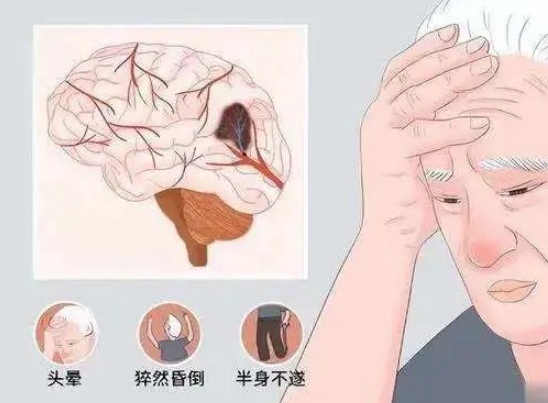 脑供血不足是什么引起的