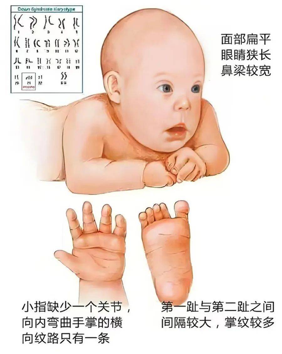 唐氏综合征高风险是什么意思