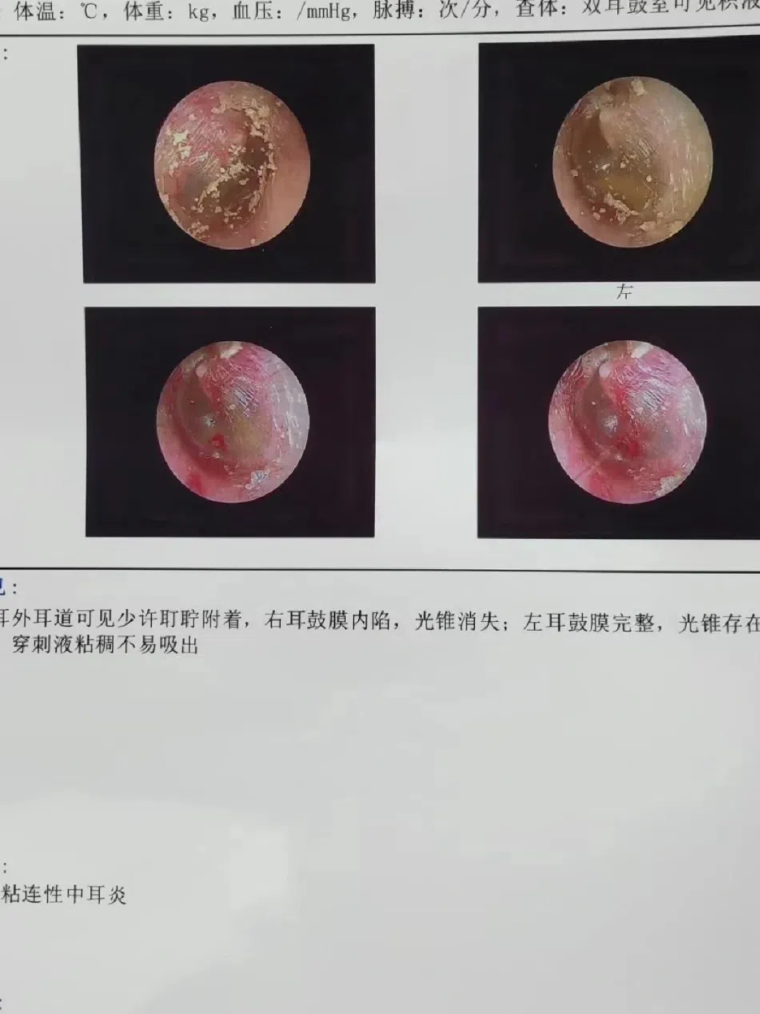 儿童中耳炎的症状有哪些?