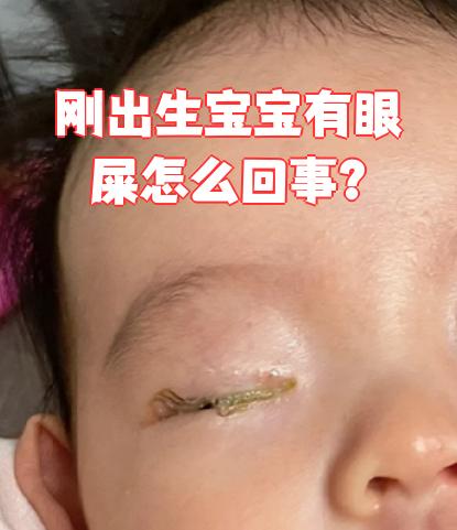 婴儿眼屎多怎么办??