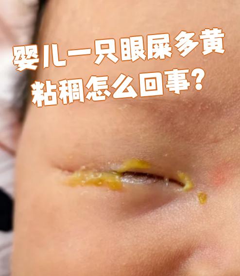 婴儿眼屎多怎么办??