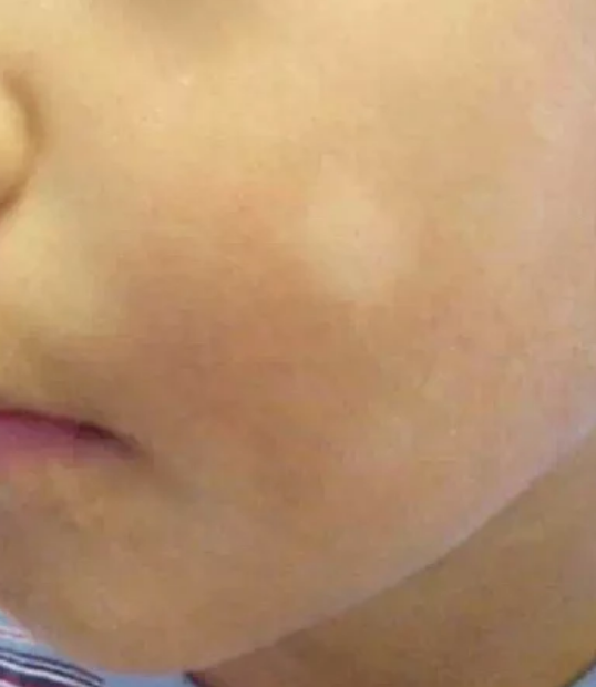 脸颊上面白癜风最早期症状图片